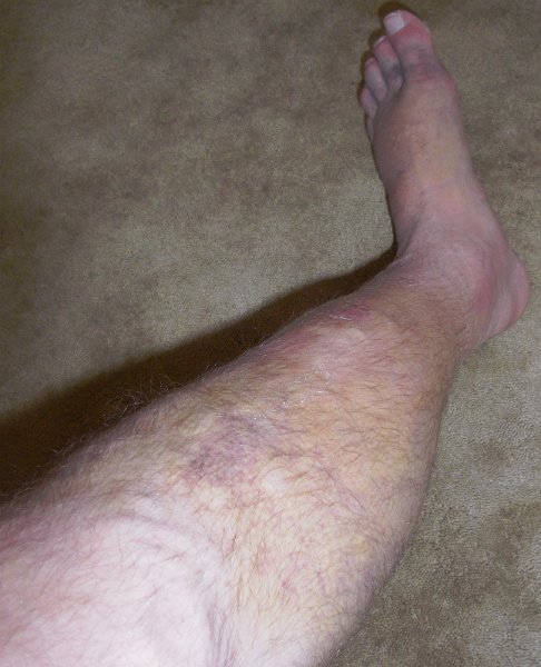 Sunday 24th June 2012.jpg - A week later. Calf and foot covered in bruising. Note the toes with various shades of grey. The Doc said this was the effect of gravity on the blood clots. 
